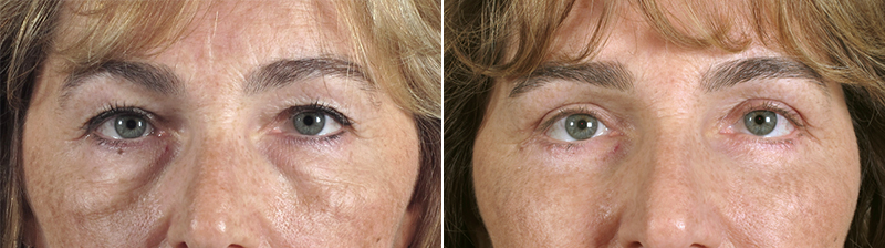 Upper & Lower Eyelid Lift Patient 12