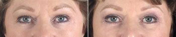Upper & Lower Eyelid Lift Patient 13