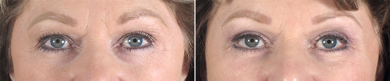 Upper & Lower Eyelid Lift Patient 13
