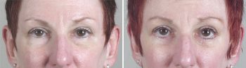 Lower Eyelid Lift Patient 6