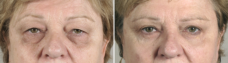 Upper & Lower Eyelid Lift Patient 14