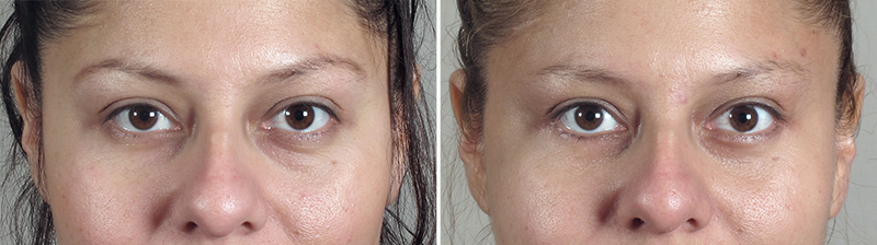Lower Eyelid Lift Patient 7