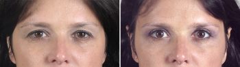 Upper Eyelid Lift Patient 10