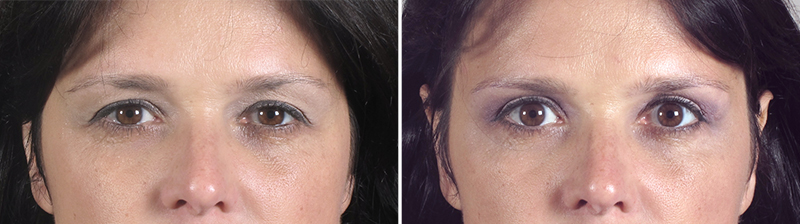 Upper Eyelid Lift Patient 10