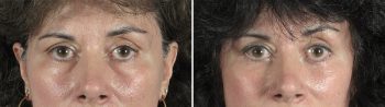 Lower Eyelid Lift Patient 8