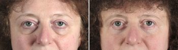 Upper & Lower Eyelid Lift Patient 15