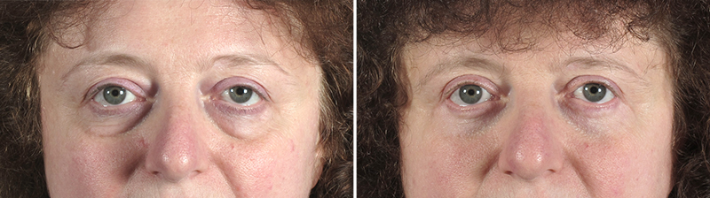 Upper & Lower Eyelid Lift Patient 15