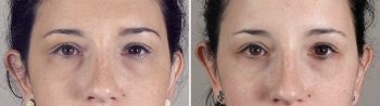 Lower Eyelid Lift Patient 9
