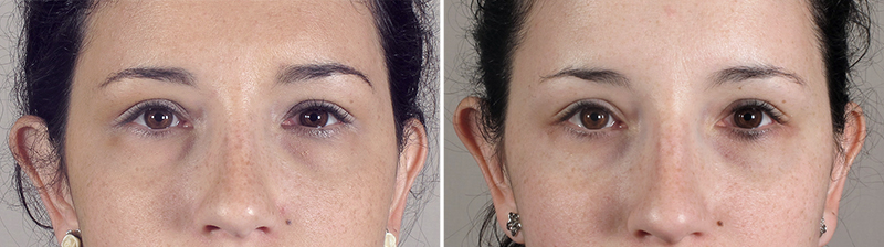 Lower Eyelid Lift Patient 9