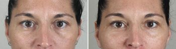 Lower Eyelid Lift Patient 10
