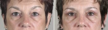 Upper Eyelid Lift Patient 11