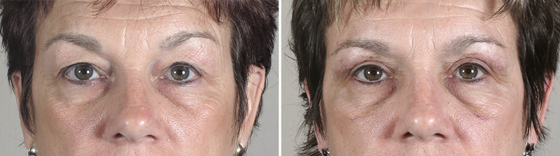Upper Eyelid Lift Patient 11