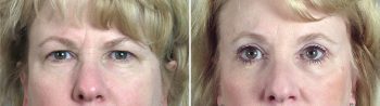 Upper & Lower Eyelid Lift Patient 3
