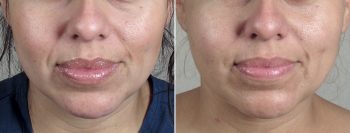 Lower Eyelid Lift Patient 7