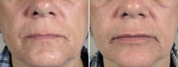 Upper Eyelid Lift Patient 11