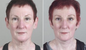 Lower Eyelid Lift Patient 6