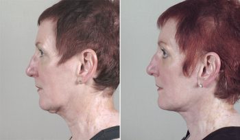 Lower Eyelid Lift Patient 6