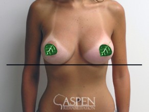 after nonsurgical treatment for capsular contracture