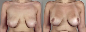 Breast Lift with Implants Patient 22