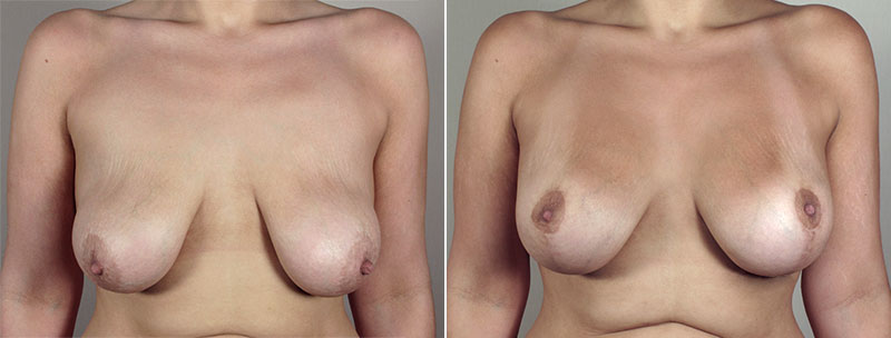 Breast Lift with Implants Patient 22