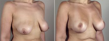 Breast Lift with Implants Patient 22
