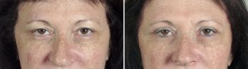 Upper Eyelid Lift Patient 13