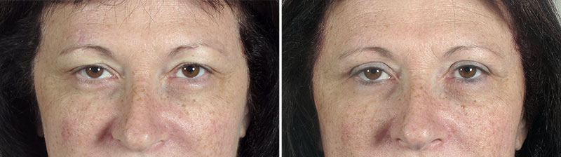 Upper Eyelid Lift Patient 13