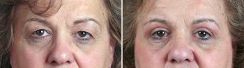 Upper Eyelid Lift Patient 16
