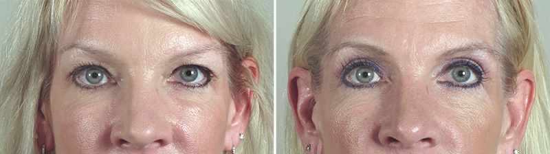 Upper Eyelid Lift Patient 15