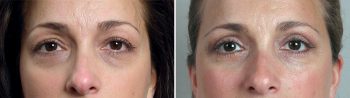 Upper & Lower Eyelid Lift Patient 16