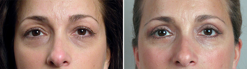 Upper & Lower Eyelid Lift Patient 16