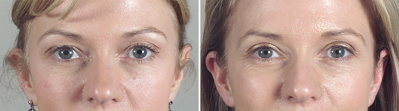 Upper Eyelid Lift Patient 12