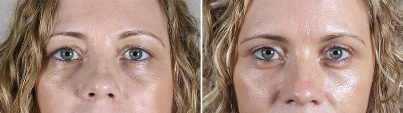 Upper Eyelid Lift Patient 14