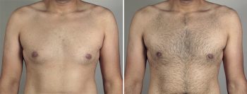 Gynecomastia Reduction Patient 34