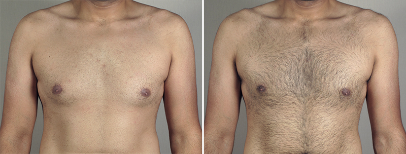 Gynecomastia Reduction Patient 34