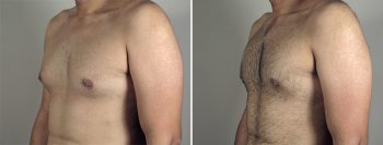 Gynecomastia Reduction Patient 34