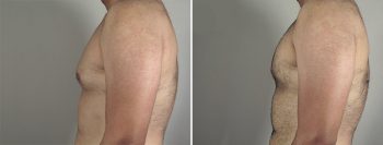 Gynecomastia Reduction Patient 34