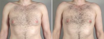 Gynecomastia Reduction Patient 35
