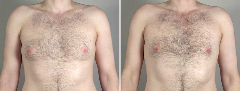 Gynecomastia Reduction Patient 35
