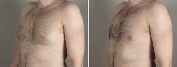 Gynecomastia Reduction Patient 35