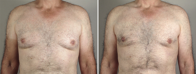 Gynecomastia Reduction Patient 36