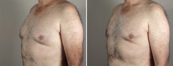Gynecomastia Reduction Patient 36