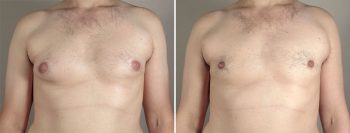 Gynecomastia Reduction Patient 37