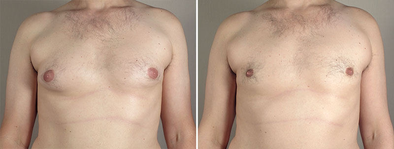 Gynecomastia Reduction Patient 37