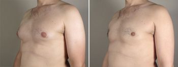 Gynecomastia Reduction Patient 37