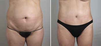 Parker Tummy Tuck Patient 27
