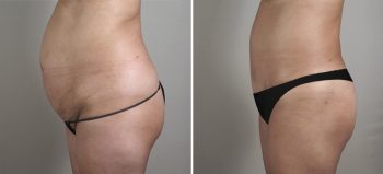 Parker Tummy Tuck Patient 27