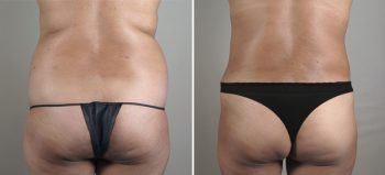 Parker Tummy Tuck Patient 27