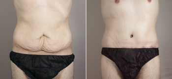 Male Abdominoplasty Patient 8
