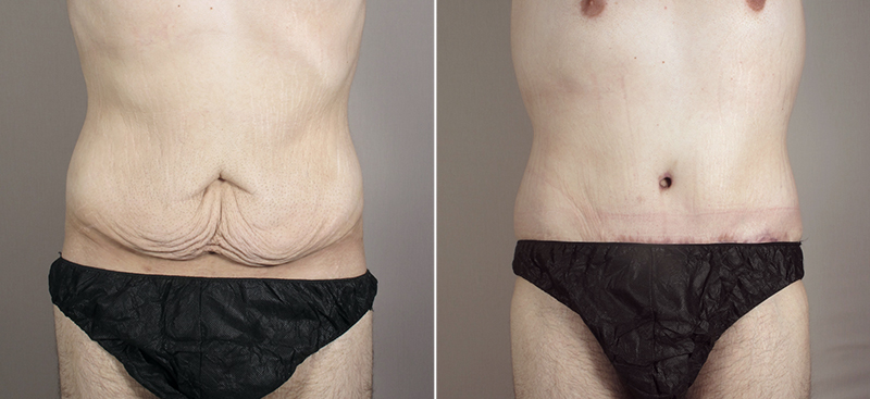 Male Abdominoplasty Patient 8